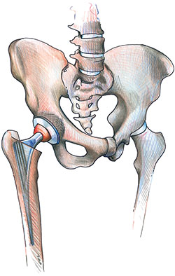 illustration Hüfte